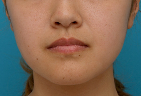 症例写真,ボツリヌストキシン注射（エラ、プチ小顔術）の症例写真 エラ改善に,2週間後,mainpic_votox02c.jpg