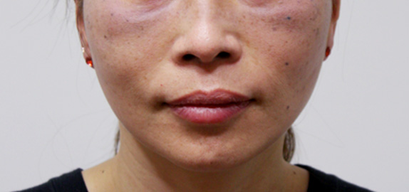 ボツリヌストキシン注射（エラ、プチ小顔術）の症例写真 筋肉タイプのエラに,After（4週間後）,ba_votox10_a01.jpg