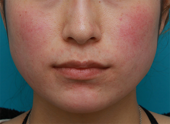 症例写真,ボツリヌストキシン注射（エラ、プチ小顔術）の症例写真,Before,ba_botox01_b.jpg