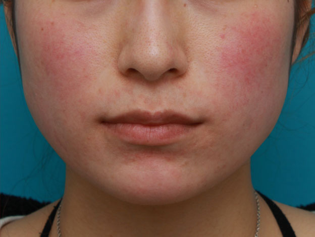 症例写真,ボツリヌストキシン注射（エラ、プチ小顔術）の症例写真,注射前,mainpic_botox01a.jpg