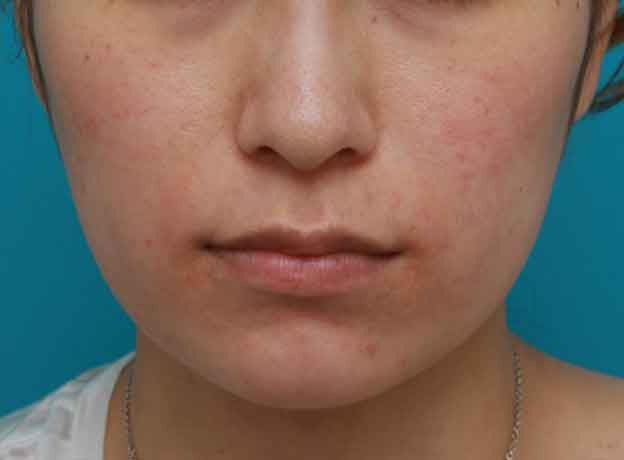 症例写真,ボツリヌストキシン注射（エラ、プチ小顔術）の症例写真,1ヶ月後,mainpic_botox01c.jpg