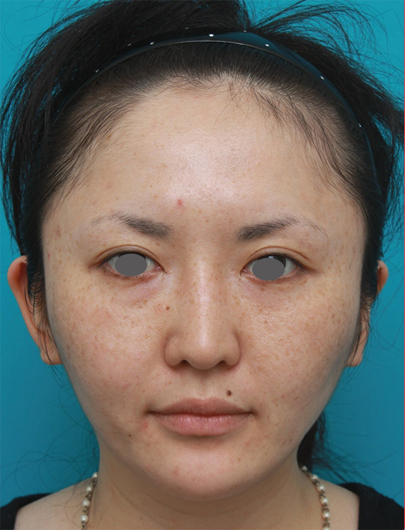 症例写真,ボツリヌストキシン注射（エラ、プチ小顔術）+頬顎イタリアン・メソシェイプ（イタリアンメソセラピー）・脂肪溶解注射+顎シリコンプロテーゼ症例写真,After,ba_botox02_b.jpg