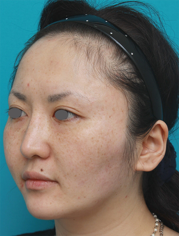 症例写真,ボツリヌストキシン注射（エラ、プチ小顔術）+頬顎イタリアン・メソシェイプ（イタリアンメソセラピー）・脂肪溶解注射+顎シリコンプロテーゼ症例写真,After,ba_botox03_b.jpg