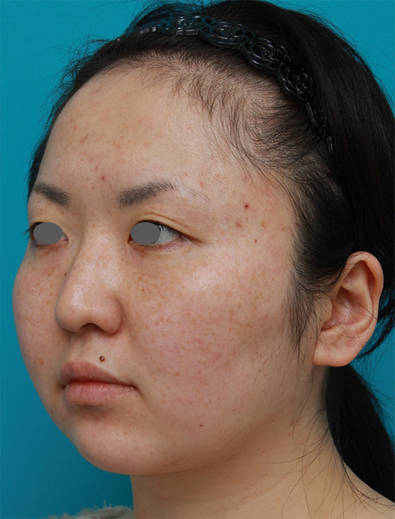症例写真,ボツリヌストキシン注射（エラ、プチ小顔術）+頬顎イタリアン・メソシェイプ（イタリアンメソセラピー）・脂肪溶解注射+顎シリコンプロテーゼ症例写真,Before,ba_botox03_b.jpg