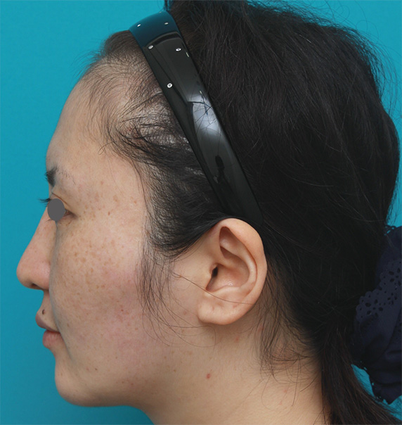 症例写真,ボツリヌストキシン注射（エラ、プチ小顔術）+頬顎イタリアン・メソシェイプ（イタリアンメソセラピー）・脂肪溶解注射+顎シリコンプロテーゼ症例写真,After,ba_botox04_b.jpg