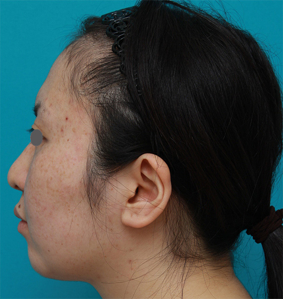 症例写真,ボツリヌストキシン注射（エラ、プチ小顔術）+頬顎イタリアン・メソシェイプ（イタリアンメソセラピー）・脂肪溶解注射+顎シリコンプロテーゼ症例写真,Before,ba_botox04_b.jpg