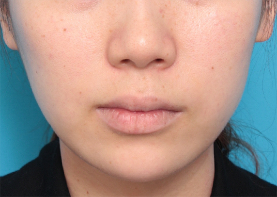 症例写真,ボツリヌストキシン注射（エラ、プチ小顔術）+顎先の長期持続型ヒアルロン酸でシャープなフェイスラインになった症例写真,After（1ヶ月後）,ba_botox05_b.jpg