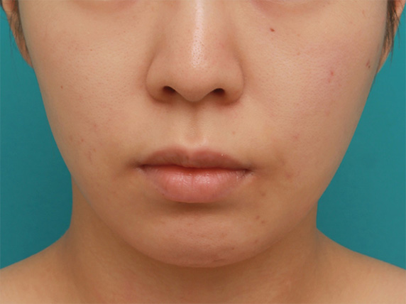 あご注射（ヒアルロン酸）,長期持続型ヒアルロン酸注射で尖った顎を作り、小顔効果を出した症例写真の術前術後画像,Before,ba_agochu39_b.jpg