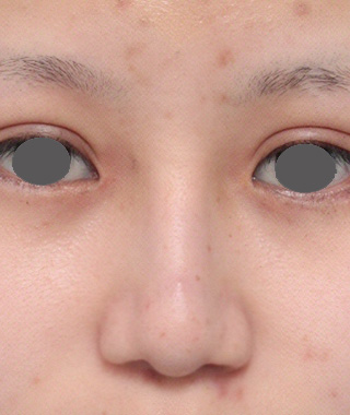 隆鼻術（シリコンプロテーゼ）,鼻尖形成（鼻尖縮小・だんご鼻修正）,鼻プロテーゼ+鼻尖形成（鼻尖縮小）症例写真,After,ba_ryubi35_a01.jpg