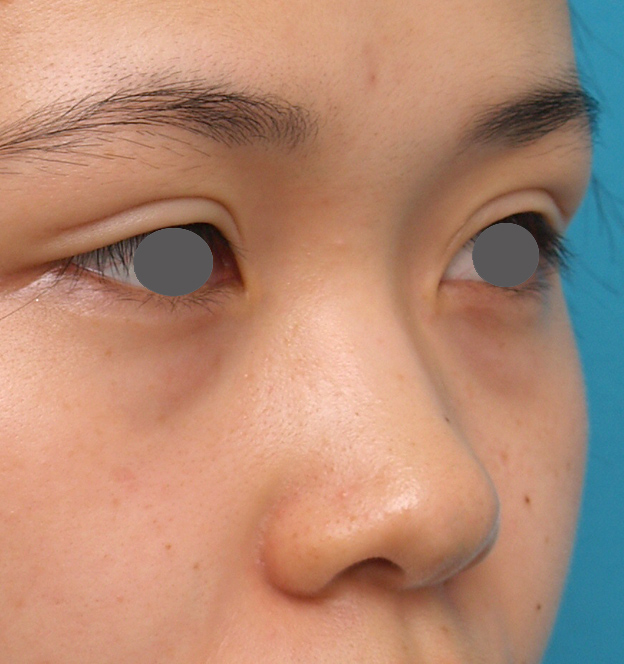耳介軟骨移植（鼻先を出す）,鼻プロテーゼ＋耳介軟骨移植＋鼻翼縮小症例写真,Before,ba_bisen13_b.jpg