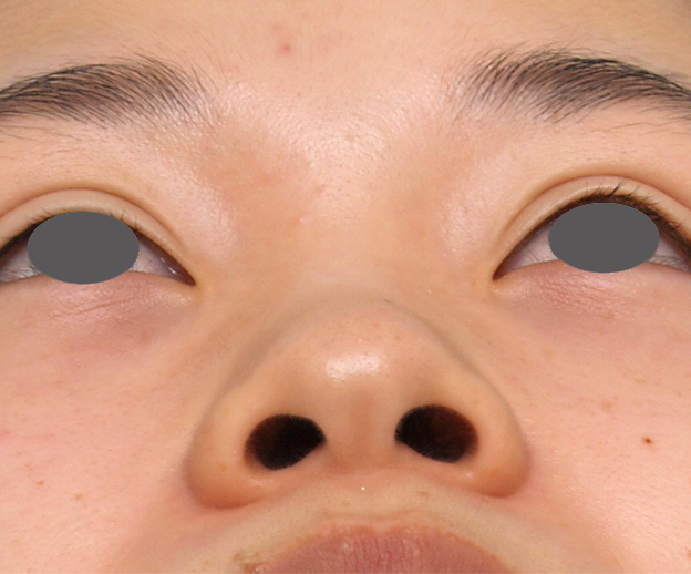 耳介軟骨移植（鼻先を出す）,鼻プロテーゼ＋耳介軟骨移植＋鼻翼縮小症例写真,Before,ba_bisen15_b.jpg