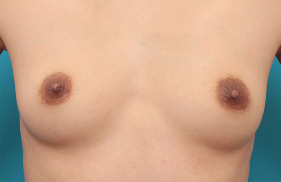 乳頭縮小手術でやや大きめな乳首を小さめにした症例写真の術前術後画像,After（3ヶ月後）,ba_nyuto31_a01.jpg