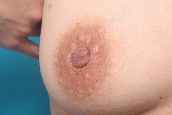 症例写真,乳輪のぶつぶつ(モントゴメリー腺)除去 乳輪の形が気になる女性の症例,After(1ヶ月後),ba_montgomery01_b.jpg