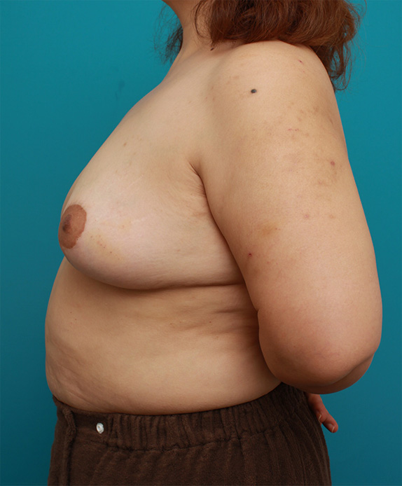 症例写真,乳房縮小手術(マンマリダクション)の症例 2週間空けて片胸ずつ手術,After2週間空けて片胸ずつ手術,ba_shukusho05_b.jpg