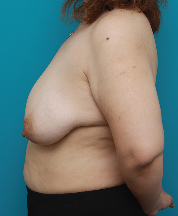 症例写真,乳房縮小手術(マンマリダクション)の症例 2週間空けて片胸ずつ手術,Before,ba_shukusho05_b.jpg