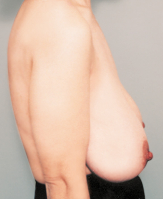 下垂乳房形成（垂れ乳修正）の症例 加齢により胸が垂れてしまった女性,Before,ba_tare05_b.jpg