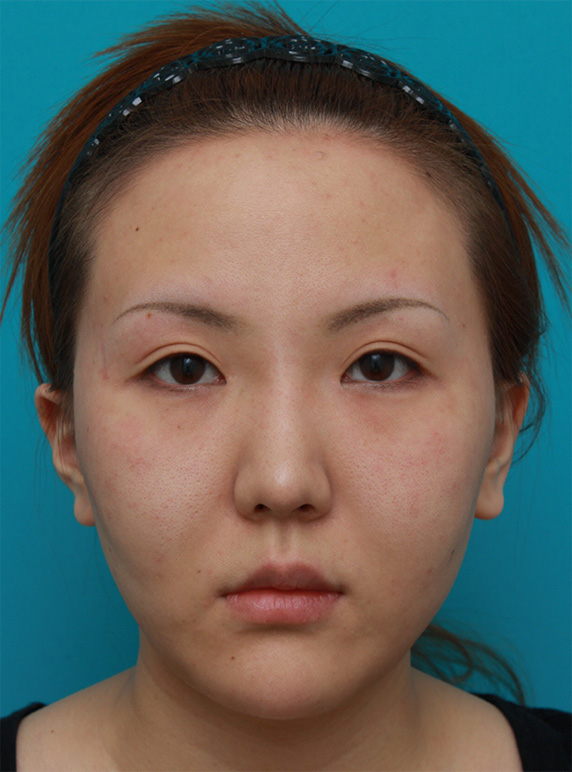 症例写真,頬、顎にイタリアン・メソシェイプ（イタリアンメソセラピー）・脂肪溶解注射を3回行い、小顔になった症例写真,After（3回目終了後2ヶ月後）,ba_meso49_b.jpg