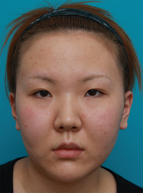 症例写真,頬、顎にイタリアン・メソシェイプ（イタリアンメソセラピー）・脂肪溶解注射を3回行い、小顔になった症例写真,Before,ba_meso49_b.jpg