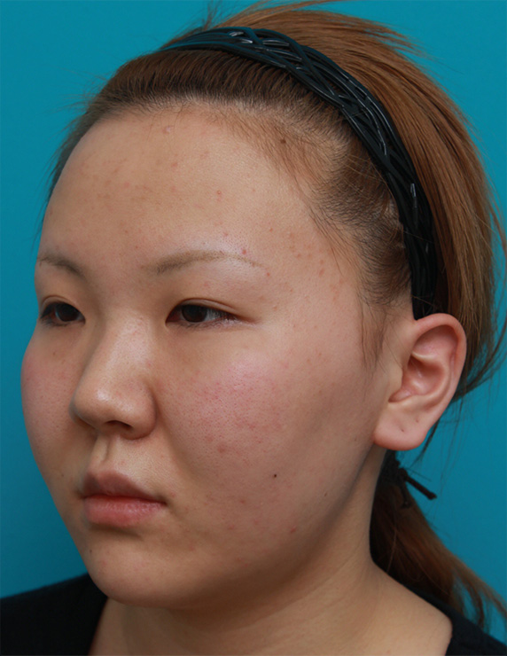 症例写真,頬、顎にイタリアン・メソシェイプ（イタリアンメソセラピー）・脂肪溶解注射を3回行い、小顔になった症例写真,Before,ba_meso50_b.jpg