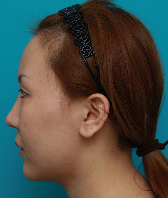 症例写真,頬、顎にイタリアン・メソシェイプ（イタリアンメソセラピー）・脂肪溶解注射を3回行い、小顔になった症例写真,After（3回目終了後2ヶ月後）,ba_meso51_b.jpg