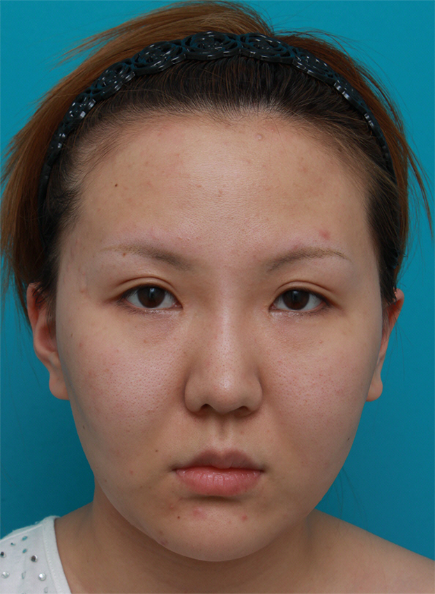 症例写真,頬、顎にイタリアン・メソシェイプ（イタリアンメソセラピー）・脂肪溶解注射を3回行い、小顔になった症例写真,1回目終了後2ヶ月後,mainpic_meso05b.jpg