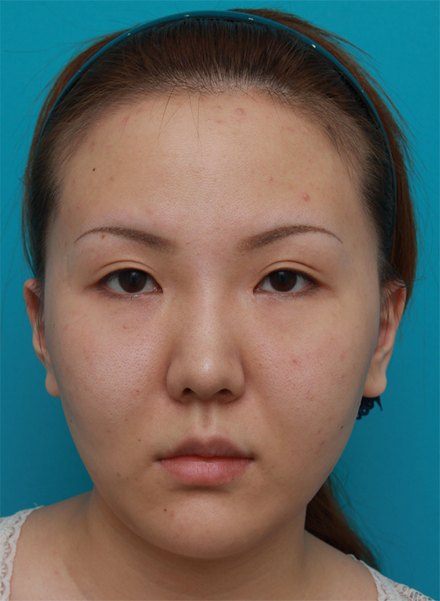 症例写真,頬、顎にイタリアン・メソシェイプ（イタリアンメソセラピー）・脂肪溶解注射を3回行い、小顔になった症例写真,2回目終了後2ヶ月後,mainpic_meso05c.jpg