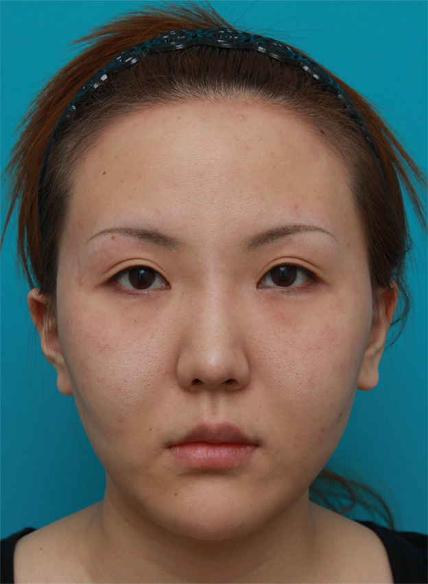 症例写真,頬、顎にイタリアン・メソシェイプ（イタリアンメソセラピー）・脂肪溶解注射を3回行い、小顔になった症例写真,3回目終了後2ヶ月後,mainpic_meso05d.jpg
