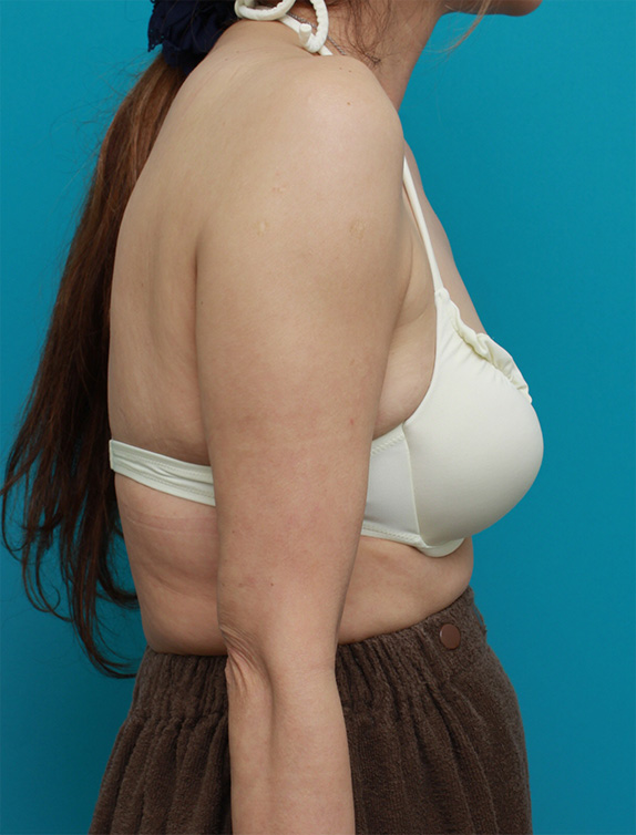 症例写真,二の腕~腕の付け根の皮下脂肪をイタリアン・メソシェイプ（イタリアンメソセラピー）・脂肪溶解注射で除去した症例写真,Before,ba_meso55_b.jpg