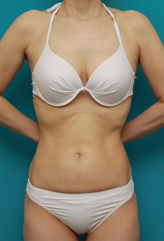症例写真,お腹回り、ウエスト、腰の皮下脂肪をイタリアン・メソシェイプ（イタリアンメソセラピー）・脂肪溶解注射で除去した症例写真,After（1クール終了後2ヶ月）,ba_meso58_b.jpg