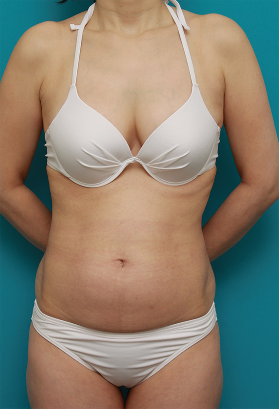 症例写真,お腹回り、ウエスト、腰の皮下脂肪をイタリアン・メソシェイプ（イタリアンメソセラピー）・脂肪溶解注射で除去した症例写真,Before,ba_meso58_b.jpg