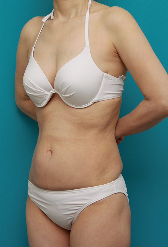 症例写真,お腹回り、ウエスト、腰の皮下脂肪をイタリアン・メソシェイプ（イタリアンメソセラピー）・脂肪溶解注射で除去した症例写真,After（1クール終了後2ヶ月）,ba_meso59_b.jpg