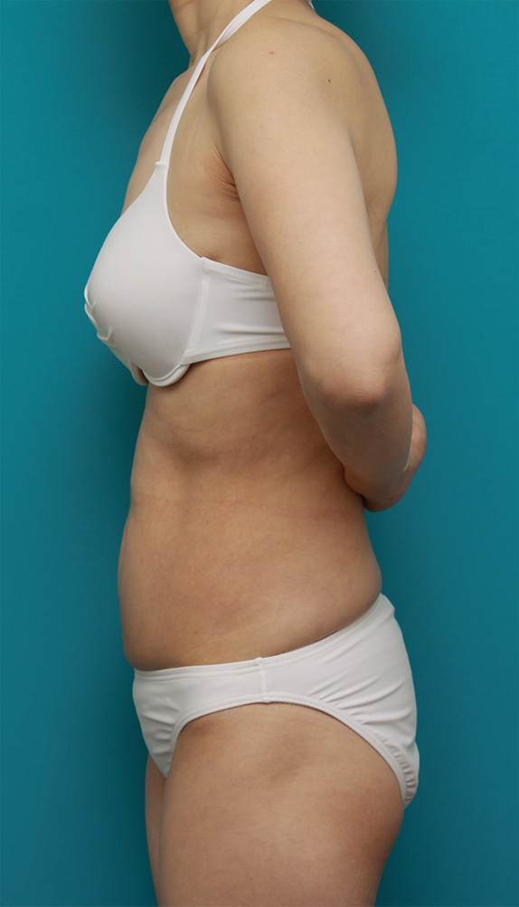 症例写真,お腹回り、ウエスト、腰の皮下脂肪をイタリアン・メソシェイプ（イタリアンメソセラピー）・脂肪溶解注射で除去した症例写真,After（1クール終了後2ヶ月）,ba_meso60_b.jpg