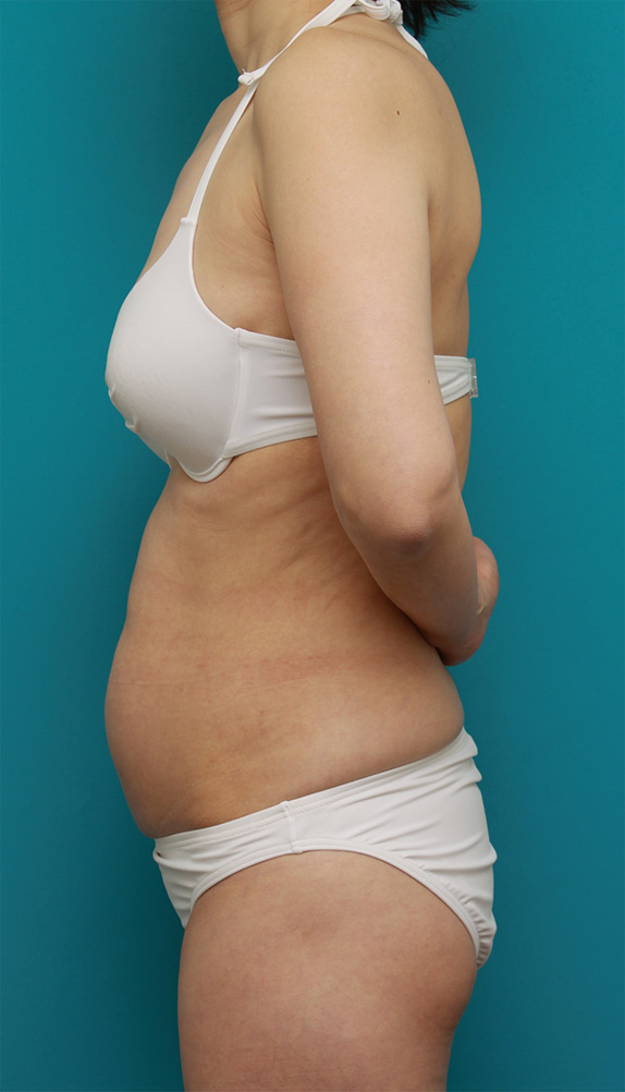 症例写真,お腹回り、ウエスト、腰の皮下脂肪をイタリアン・メソシェイプ（イタリアンメソセラピー）・脂肪溶解注射で除去した症例写真,Before,ba_meso60_b.jpg