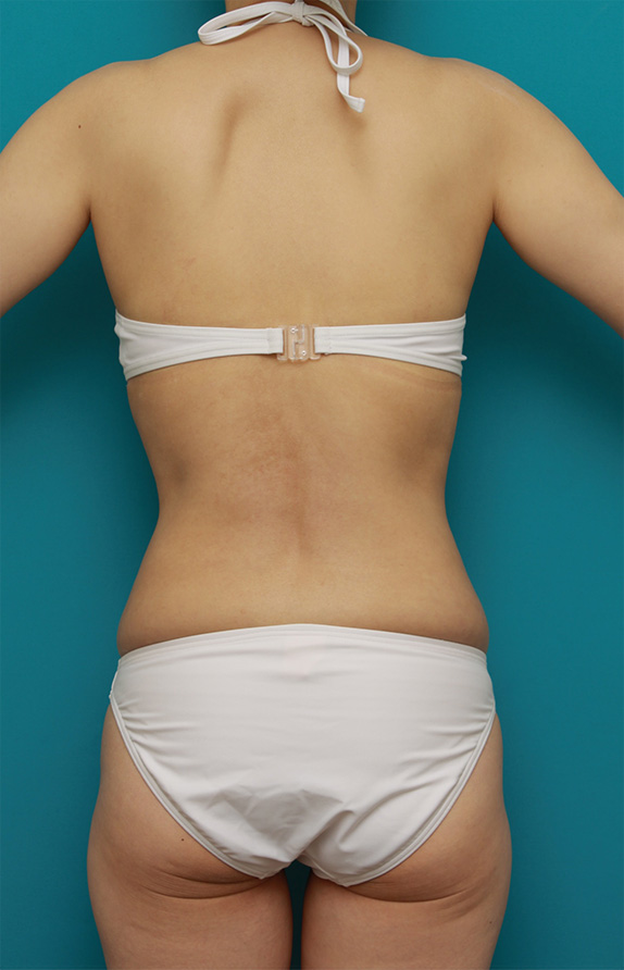 症例写真,お腹回り、ウエスト、腰の皮下脂肪をイタリアン・メソシェイプ（イタリアンメソセラピー）・脂肪溶解注射で除去した症例写真,After（1クール終了後2ヶ月）,ba_meso61_b.jpg