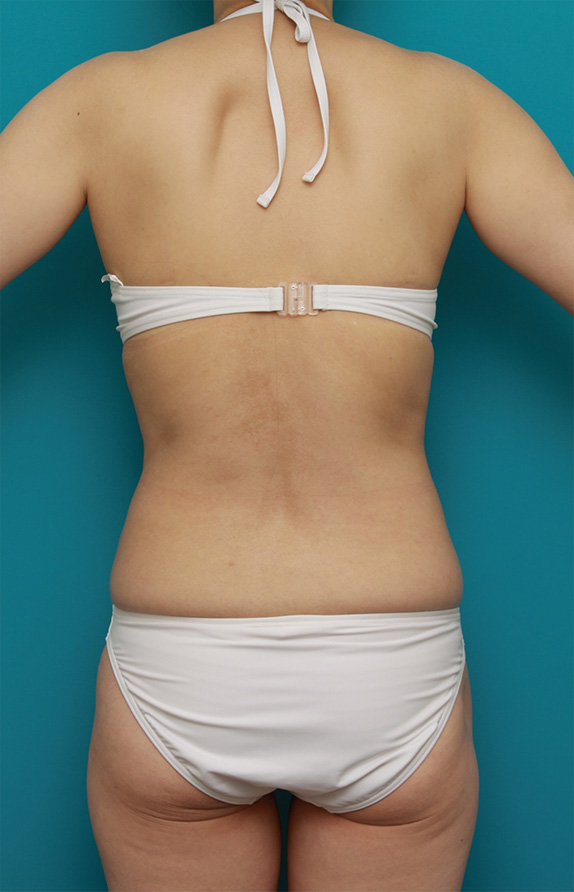 症例写真,お腹回り、ウエスト、腰の皮下脂肪をイタリアン・メソシェイプ（イタリアンメソセラピー）・脂肪溶解注射で除去した症例写真,Before,ba_meso61_b.jpg