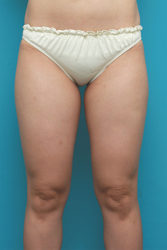 症例写真,イタリアン・メソシェイプ（イタリアンメソセラピー）・脂肪溶解注射で太ももが一周り細くなった症例写真,Before,ba_meso71_b.jpg