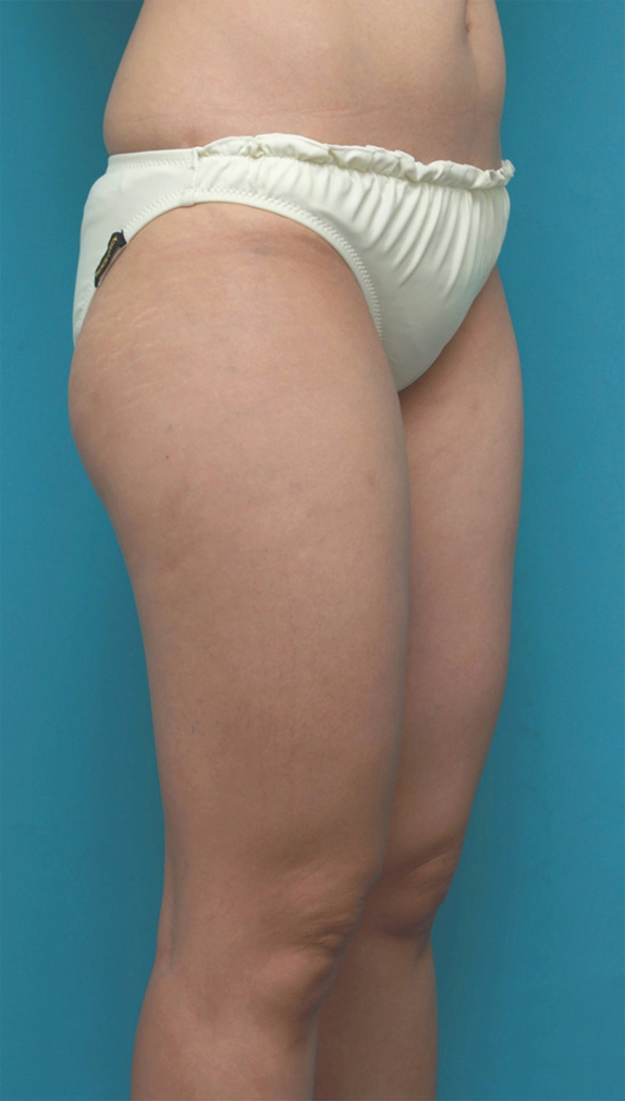 症例写真,イタリアン・メソシェイプ（イタリアンメソセラピー）・脂肪溶解注射で太ももが一周り細くなった症例写真,Before,ba_meso72_b.jpg