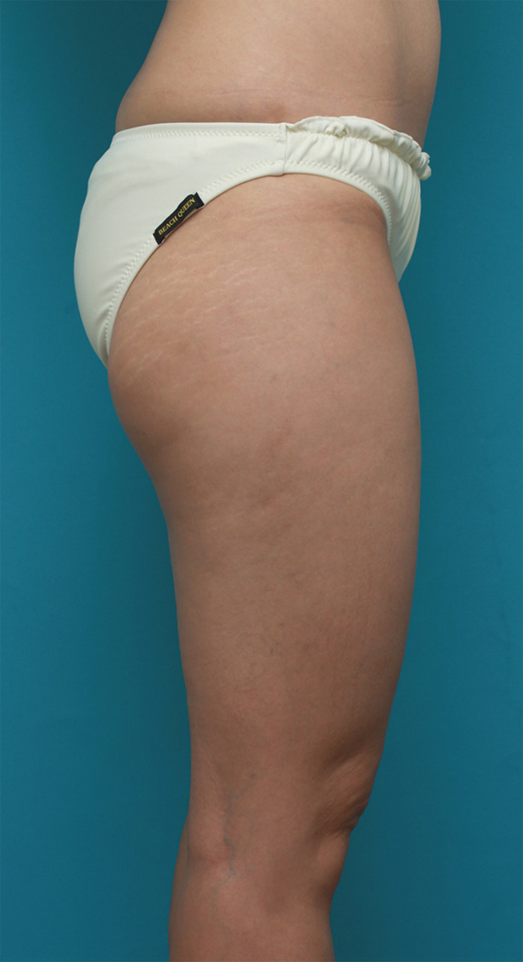 症例写真,イタリアン・メソシェイプ（イタリアンメソセラピー）・脂肪溶解注射で太ももが一周り細くなった症例写真,Before,ba_meso73_b.jpg