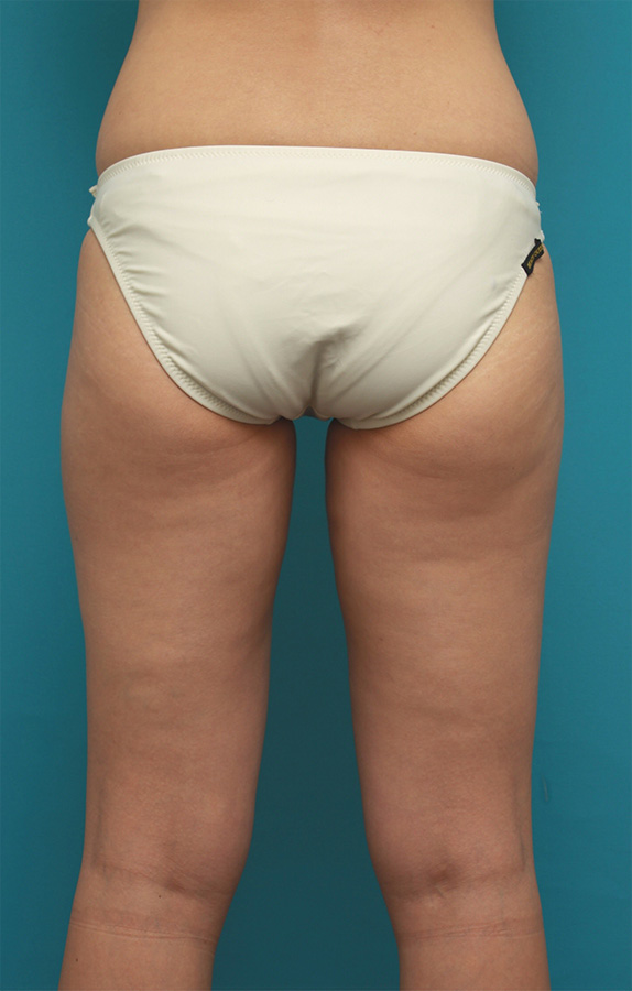 症例写真,イタリアン・メソシェイプ（イタリアンメソセラピー）・脂肪溶解注射で太ももが一周り細くなった症例写真,After（6回目注射後2ヶ月）,ba_meso74_b.jpg