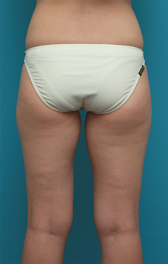 症例写真,イタリアン・メソシェイプ（イタリアンメソセラピー）・脂肪溶解注射で太ももが一周り細くなった症例写真,Before,ba_meso74_b.jpg