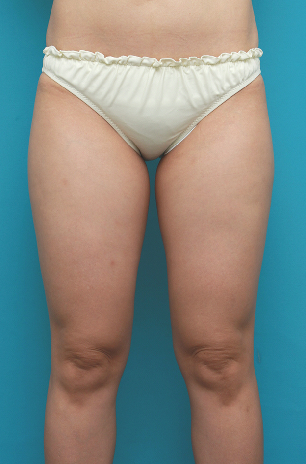 症例写真,イタリアン・メソシェイプ（イタリアンメソセラピー）・脂肪溶解注射で太ももが一周り細くなった症例写真,治療前,mainpic_meso07a.jpg