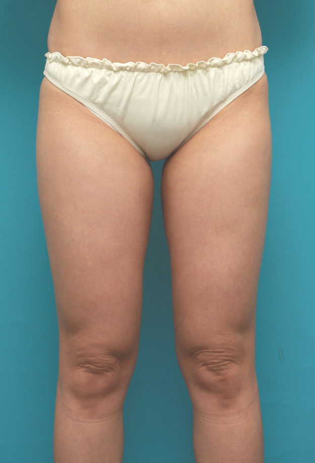 症例写真,イタリアン・メソシェイプ（イタリアンメソセラピー）・脂肪溶解注射で太ももが一周り細くなった症例写真,6回目注射後2ヶ月,mainpic_meso07c.jpg