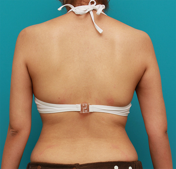 症例写真,イタリアン・メソシェイプ（イタリアンメソセラピー）・脂肪溶解注射で二の腕、わき、背中の皮下脂肪をとった症例写真,After（6回注射後）,ba_meso78_b.jpg
