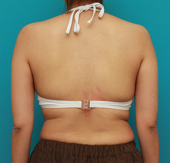 症例写真,イタリアン・メソシェイプ（イタリアンメソセラピー）・脂肪溶解注射で二の腕、わき、背中の皮下脂肪をとった症例写真,Before,ba_meso78_b.jpg
