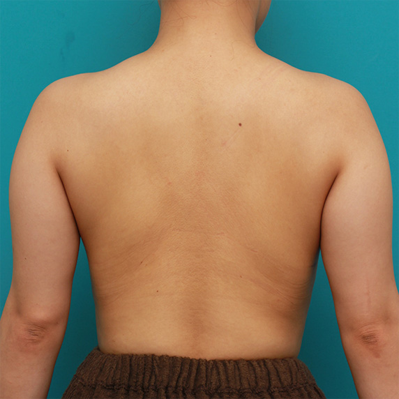 症例写真,二の腕から背中、肩にかけての皮下脂肪をイタリアン・メソシェイプ（イタリアンメソセラピー）・脂肪溶解注射で細くした症例写真,Before,ba_meso81_b.jpg