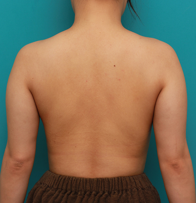 症例写真,二の腕から背中、肩にかけての皮下脂肪をイタリアン・メソシェイプ（イタリアンメソセラピー）・脂肪溶解注射で細くした症例写真,4回目注射終了後,mainpic_meso09h.jpg