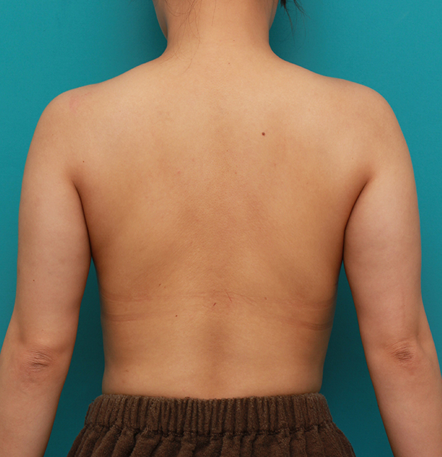 症例写真,二の腕から背中、肩にかけての皮下脂肪をイタリアン・メソシェイプ（イタリアンメソセラピー）・脂肪溶解注射で細くした症例写真,6回目注射終了後,mainpic_meso09i.jpg