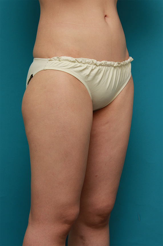 症例写真,お尻から太もも全体にかけてイタリアン・メソシェイプ（イタリアンメソセラピー）・脂肪溶解注射を行い、一回り細くした症例写真,After（6回目注射後）,ba_meso83_b.jpg