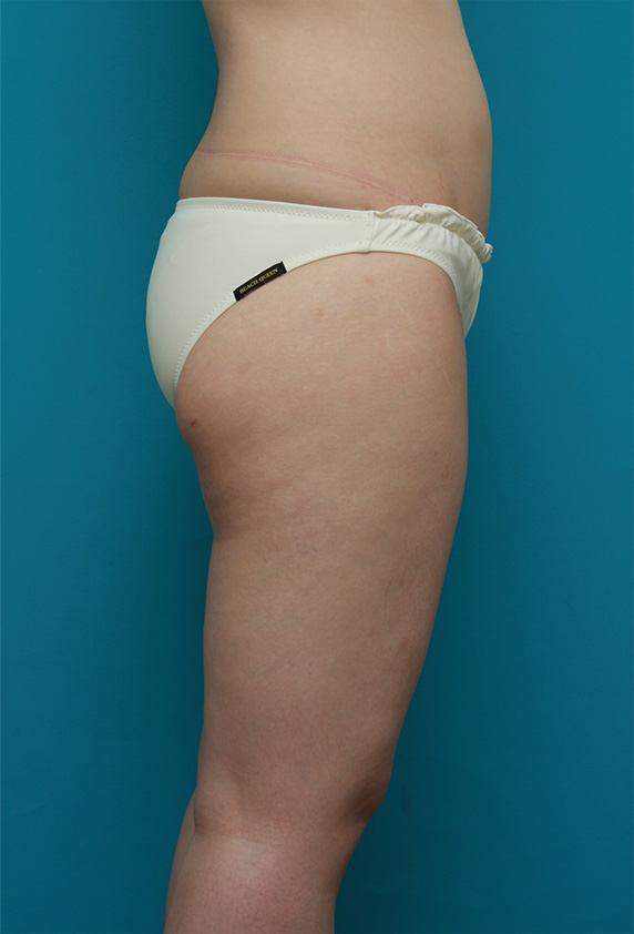 症例写真,お尻から太もも全体にかけてイタリアン・メソシェイプ（イタリアンメソセラピー）・脂肪溶解注射を行い、一回り細くした症例写真,Before,ba_meso84_b.jpg