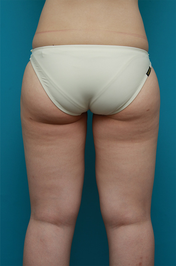 症例写真,お尻から太もも全体にかけてイタリアン・メソシェイプ（イタリアンメソセラピー）・脂肪溶解注射を行い、一回り細くした症例写真,Before,ba_meso87_b.jpg